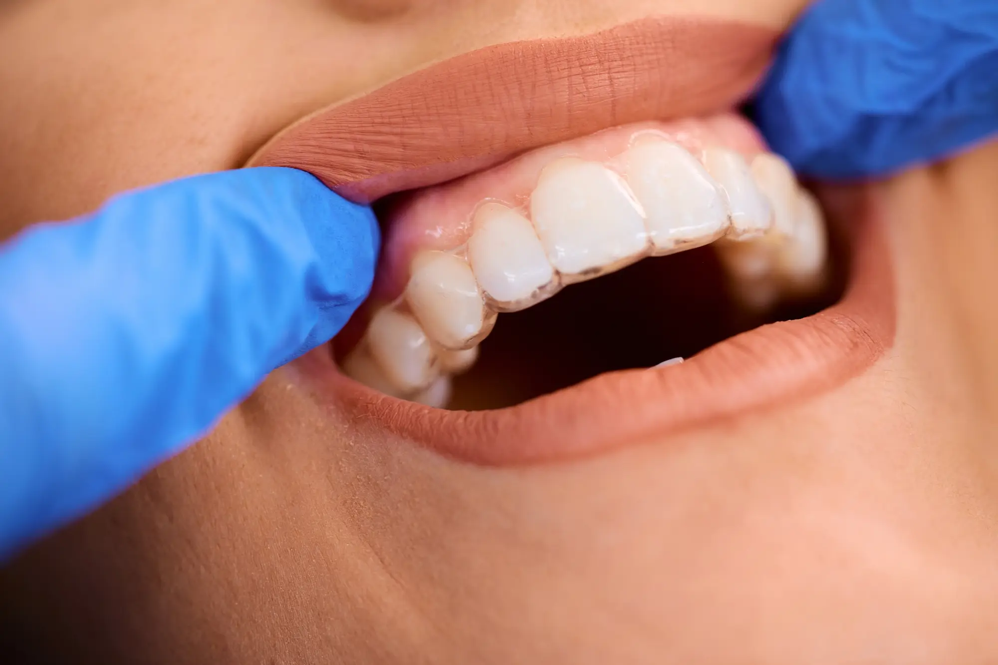 close-up-of-woman-getting-dental-aligner-on-her-te-2024-12-13-17-08-03-utc