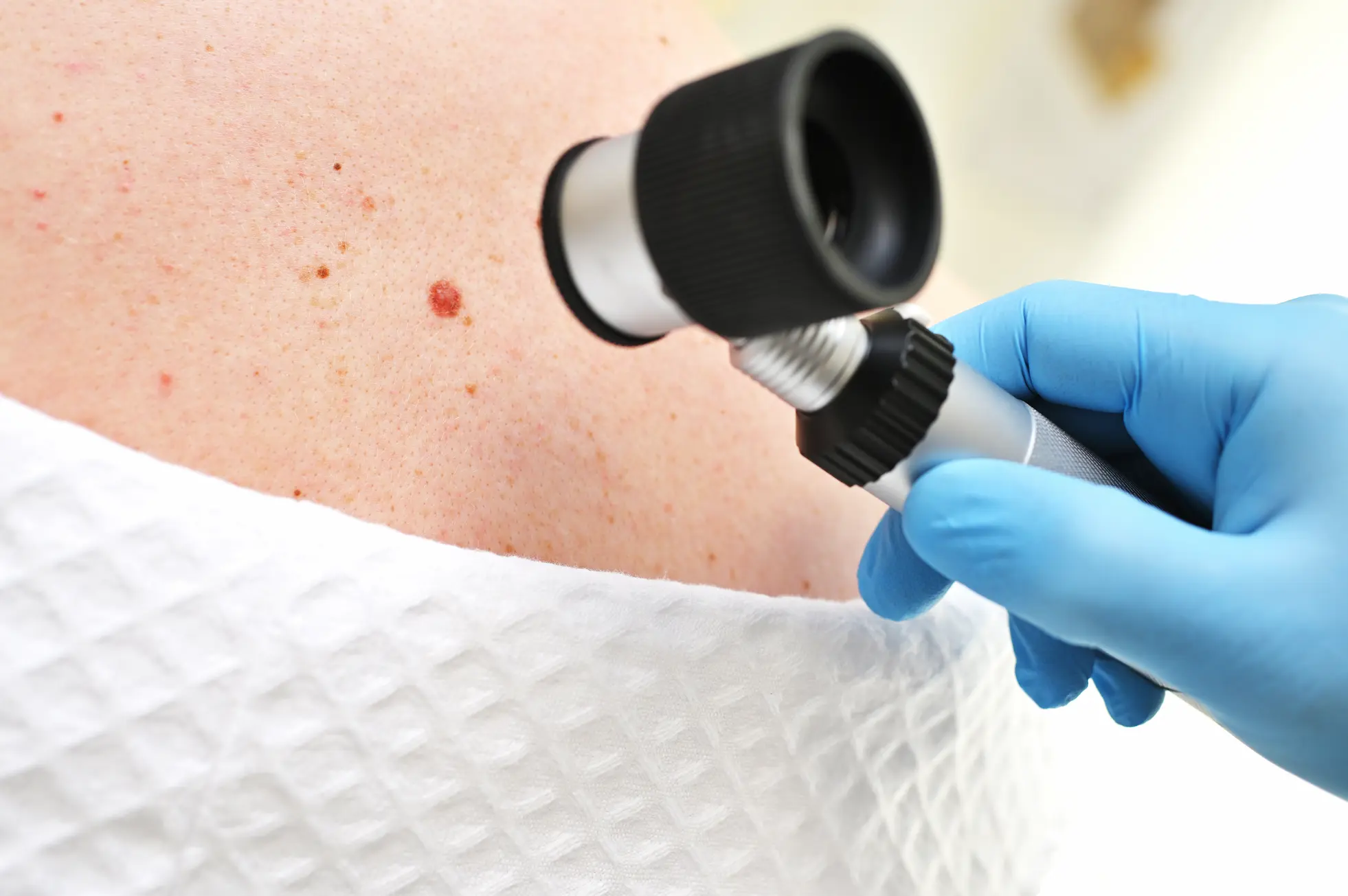dermatologist-oncologist-uses-a-dermatoscope-to-ex-2025-01-07-06-20-24-utc