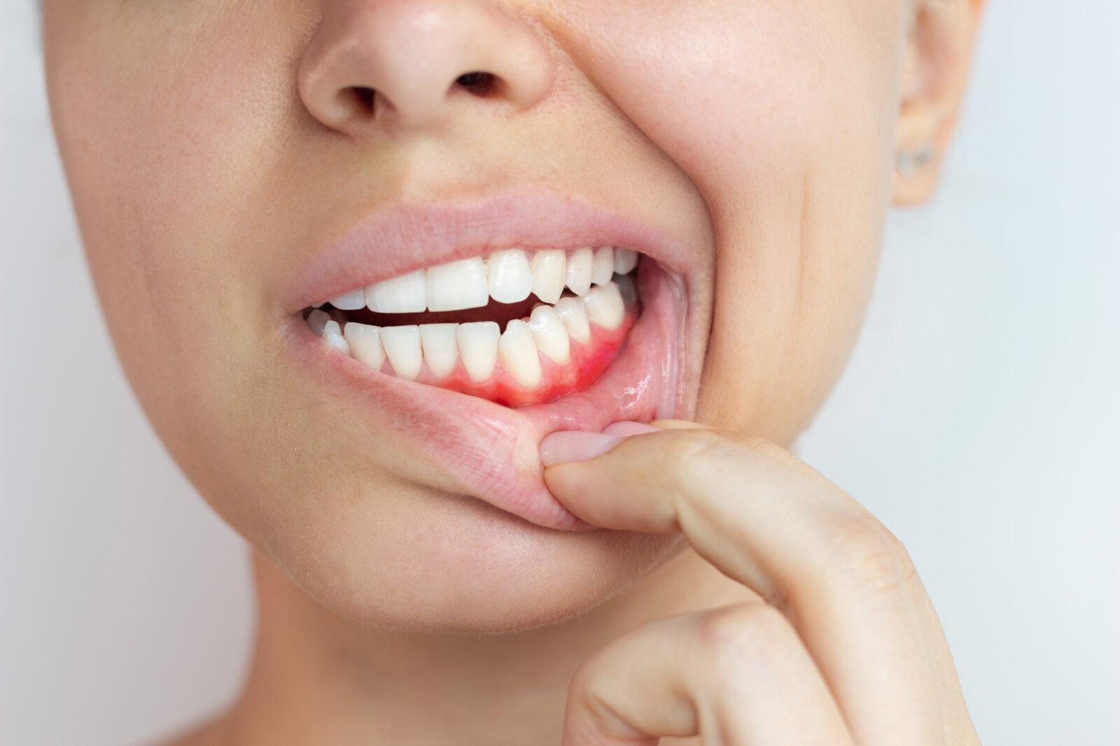 gum-inflammation-cropped-shot-young-woman-showing-red-bleeding-gums-redness-gingiva