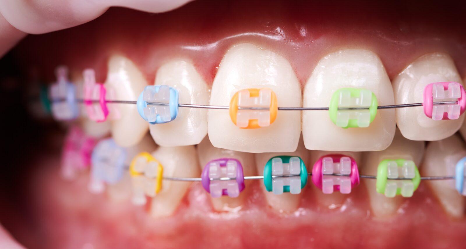macro-snapshot-of-white-teeth-and-ceramic-braces-with-colorful-rubber-bands-on-them