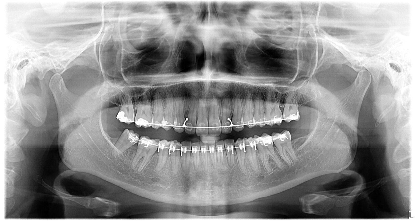 x-ray-of-a-skull-mouth-and-teeth-with-braces-orthodontics-and-dental-imagery